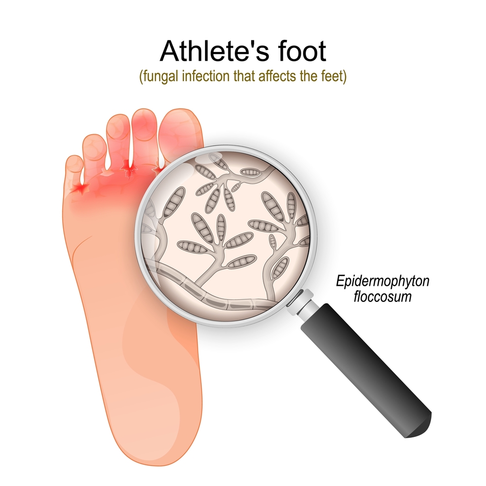 Athlete's,Foot.,Fungal,Infection,That,Affects,The,Feet.,Close up,Of