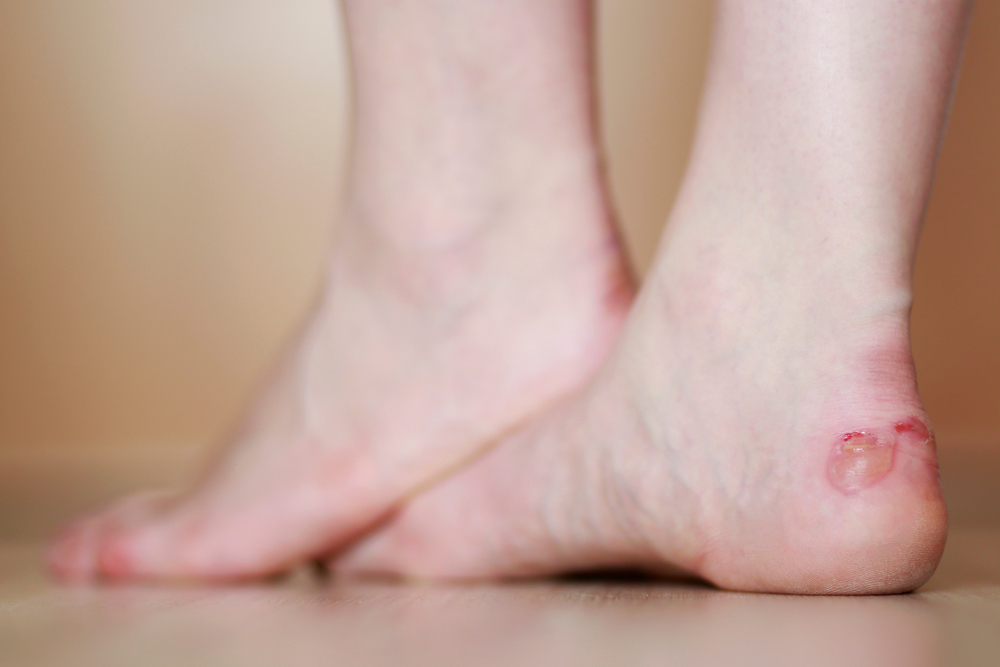 blisters on feet