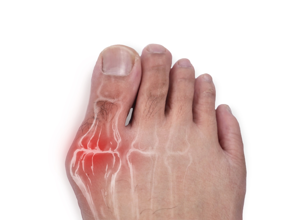 Close,Up,Of,Foot,With,Bunion,Problem,,Hallux,Valgus,,Digital