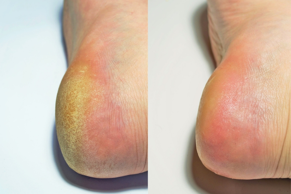 Before,And,After,Image,Showing,A,Dry,Dehydrated,Heel,And