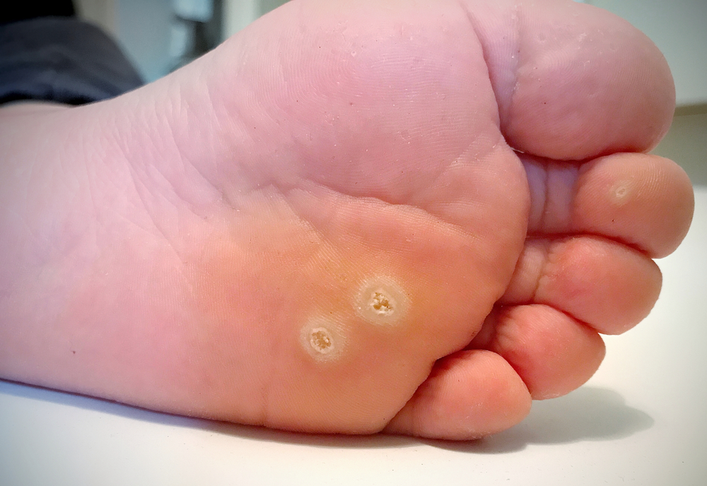 foot corn