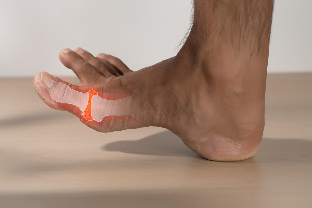 Gout,Or,Inflammatory,Arthritis,In,A,Men.,High,Uric,Acid,