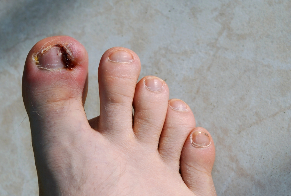 Right,Man's,Foot, ,Ingrown,Toenail