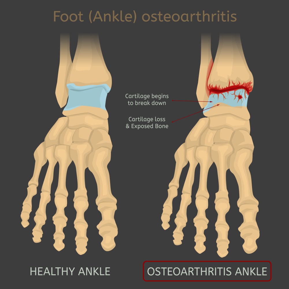 Foot,Arthritis,Image.,Ankle,Osteoarthritis.,Joint,Pain,In,Human,Feet.