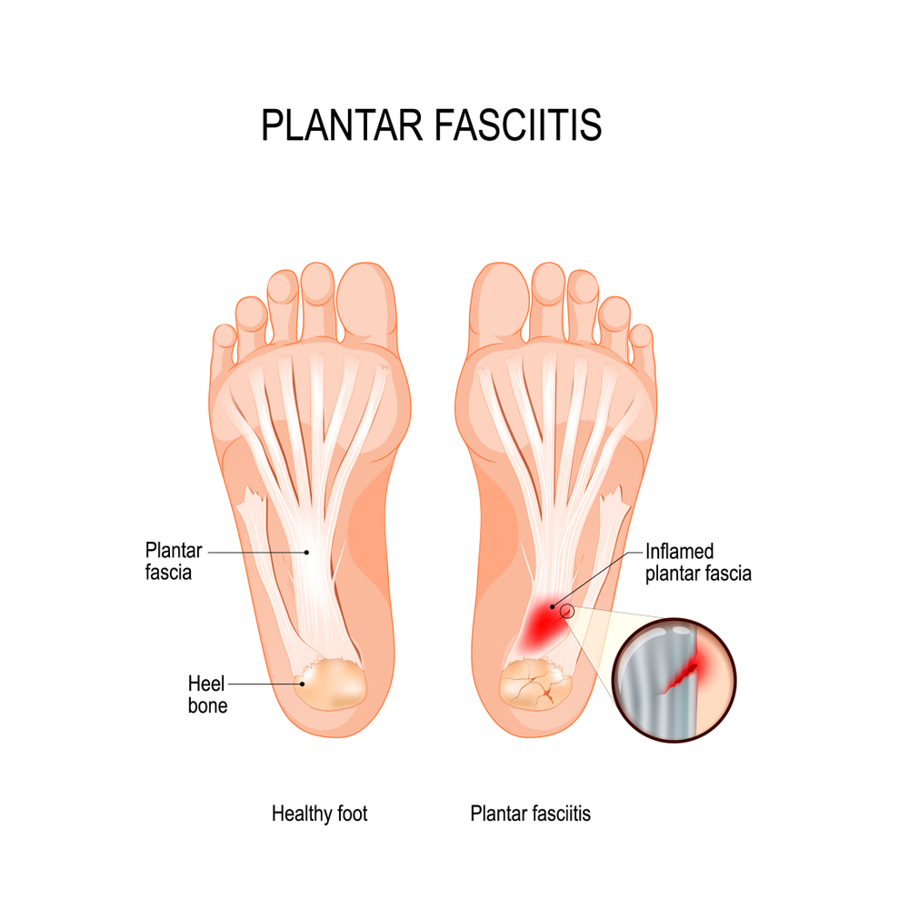 Plantar,Fasciitis.,Disorder,Of,The,Connective,Tissue,Which,Supports,The