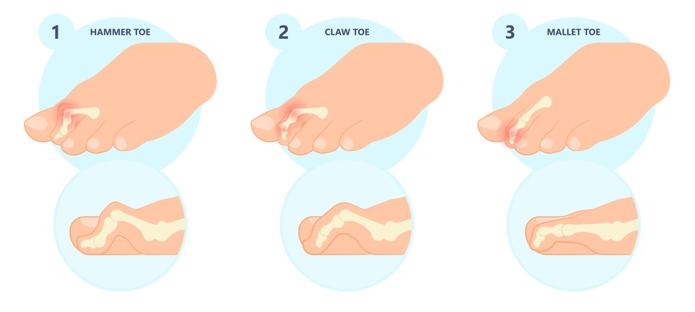 toe deformities